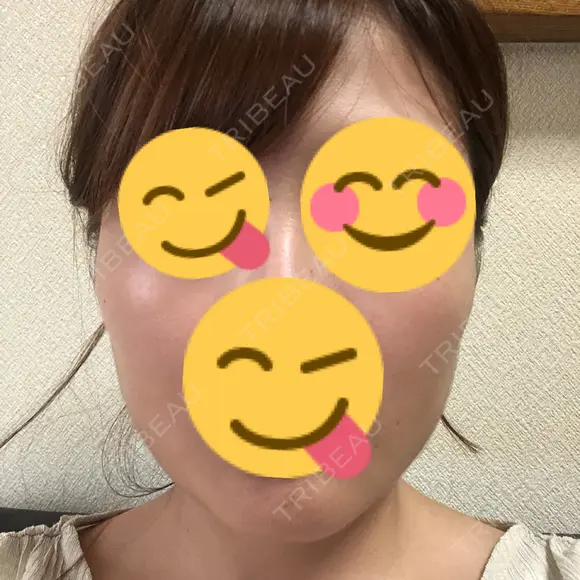 脂肪溶解注射（顔） 聖心美容クリニック 広島院 DAY 23 メイン用