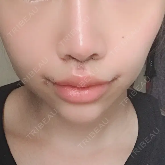 人中短縮 / 口角挙上 清潭女神美容外科 DAY 8 メイン用