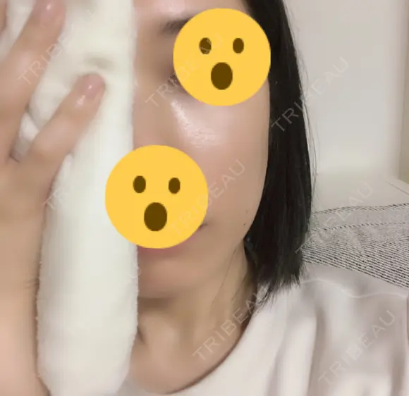 骨削り（頬） / 輪郭修正 マックスファクス銀座クリニック DAY 8 メイン用