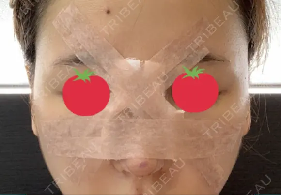 鼻尖形成（切開） / 鼻中隔延長（切開） / 軟骨移植 / 骨切幅寄せ / ワシ鼻修正・ハンプ切除 / 眉間プロテーゼ グロービー美容整形外科 DAY 1 メイン用