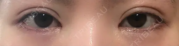 二重埋没 / 目頭切開 / 眼瞼下垂（切開） / 目尻切開 グロービー美容整形外科 DAY 54 メイン用