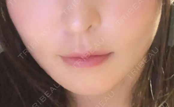 骨切り（あご） / 輪郭修正 / ボトックス（エラ・小顔） 心斎橋コムロ美容外科クリニック AFTER メイン用