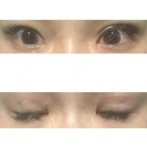 眼瞼下垂（切開） ピュア形成外科医院 AFTER メイン用