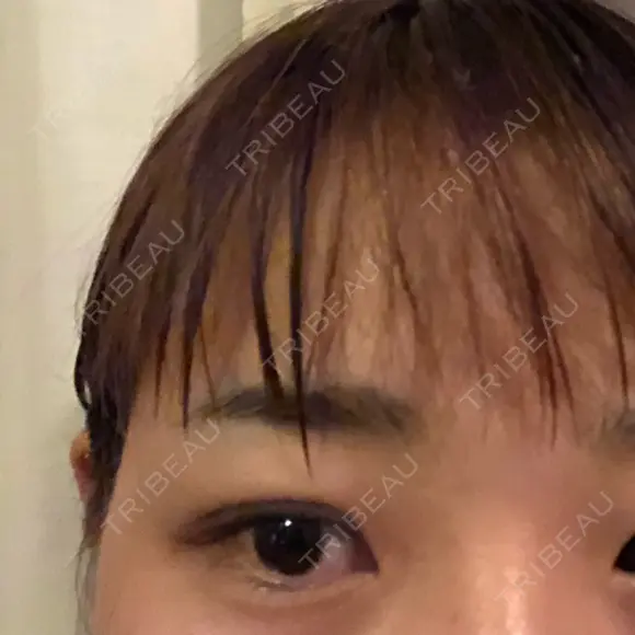 二重埋没 城本クリニック 姫路院 AFTER メイン用