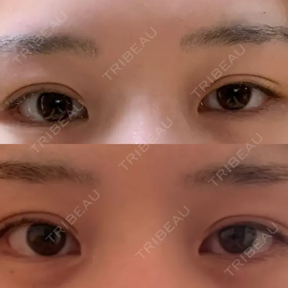 ボトックス（タレ目） 新宿ラクル美容外科クリニック 新宿院 AFTER メイン用