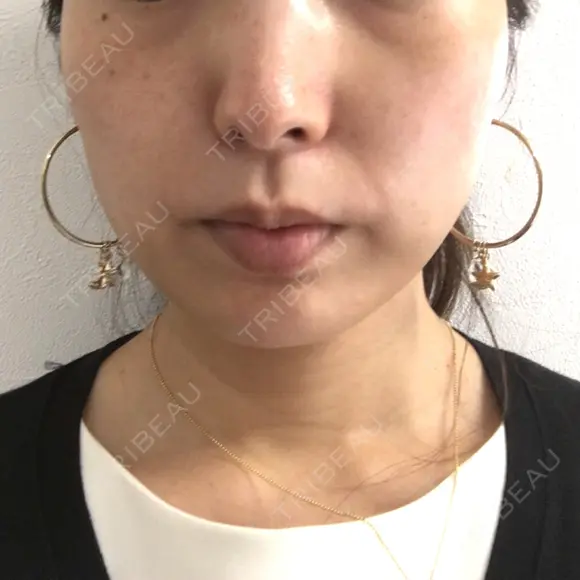 脂肪溶解注射（顔） ビクアスクリニック DAY 25 メイン用