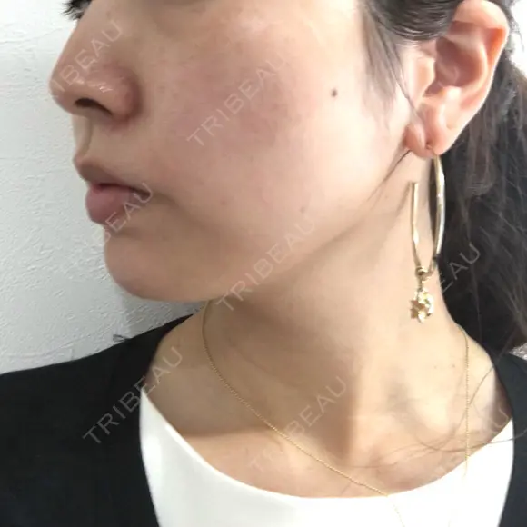 脂肪溶解注射（顔） ビクアスクリニック DAY 25 メイン用