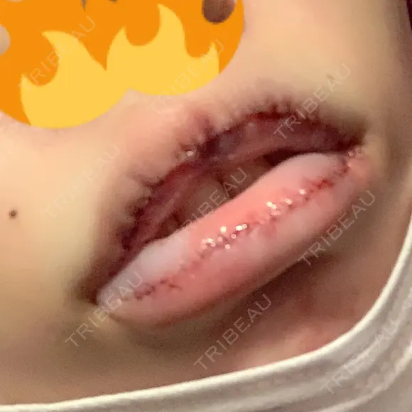 口唇縮小術 / PRP皮膚再生療法 品川スキンクリニック福岡院 DAY 0 メイン用