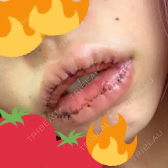 口唇縮小術 / PRP皮膚再生療法 品川スキンクリニック福岡院 DAY 1 メイン用