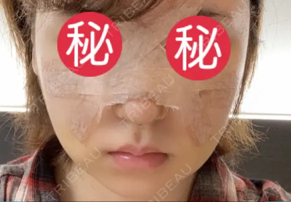 鼻尖形成（切開） / 鼻中隔延長（切開） / 軟骨移植 / 骨切幅寄せ / ワシ鼻修正・ハンプ切除 / 眉間プロテーゼ グロービー美容整形外科 DAY 6 メイン用