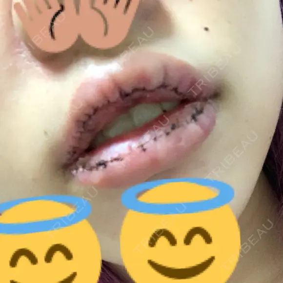 口唇縮小術 / PRP皮膚再生療法 品川スキンクリニック福岡院 DAY 2 メイン用