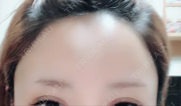 脂肪注入（肌） / 再生医療 / PRP皮膚再生療法 iSTAR美容外科・皮膚科 DAY 61 メイン用