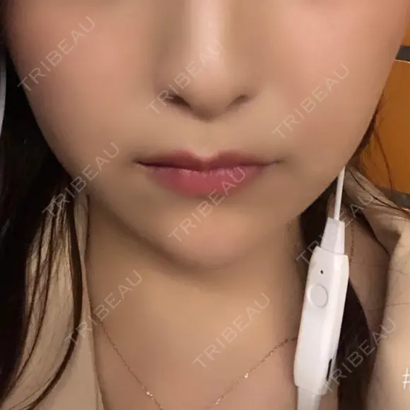 ヒアルロン酸注入（あご） TCB東京中央美容外科 世田谷院 AFTER メイン用