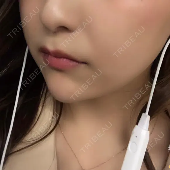 ヒアルロン酸注入（あご） TCB東京中央美容外科 世田谷院 DAY 0 メイン用