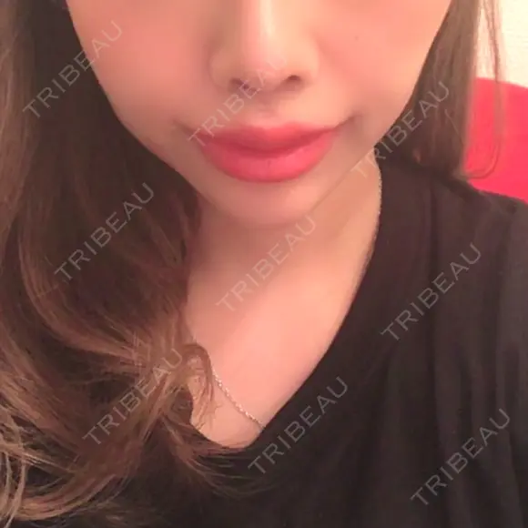 人中短縮 / 口角挙上 清潭女神美容外科 DAY 13 メイン用