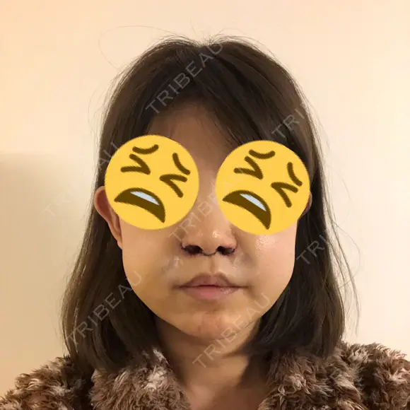 人中短縮 / 鼻翼挙上 大阪TAクリニック DAY 217 メイン用