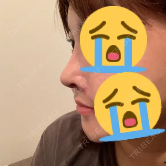 隆鼻術 / 鼻尖形成（切開） / 鼻孔縁挙上 / 鼻尖縮小 加美（GAMI）整形外科 DAY 11 メイン用