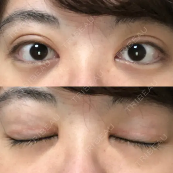 二重切開 / 目頭切開 / ほくろ・いぼ切除（肌） / 上まぶたたるみ取り / 上まぶたの脂肪取り 東京美容外科 銀座院 DAY 108 メイン用