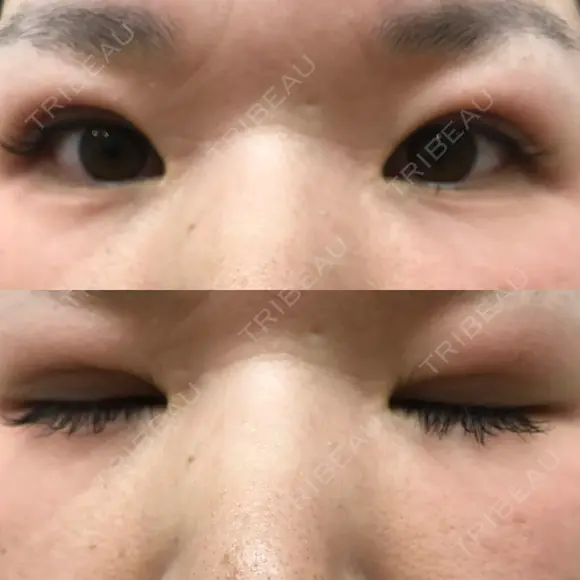 二重埋没 メディカルビューティセンター AFTER メイン用