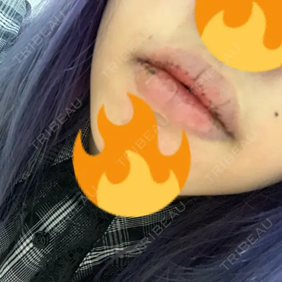 口唇縮小術 / PRP皮膚再生療法 品川スキンクリニック福岡院 DAY 6 メイン用