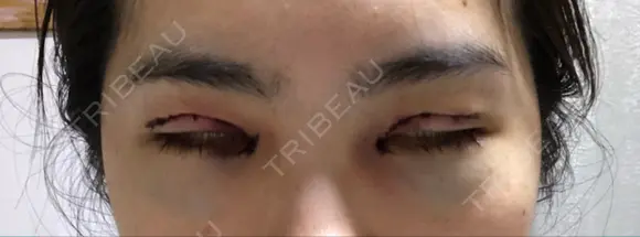 二重切開 / 目頭切開 / 眼瞼下垂（切開） / 目尻切開 ジュエリー美容外科 DAY 1 メイン用