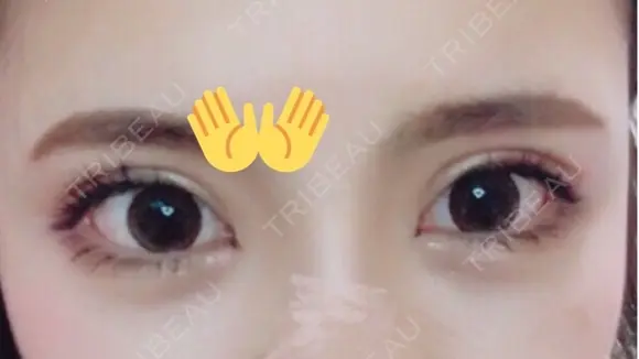 二重切開 / 目頭切開 / 眼瞼下垂（切開） / 目尻切開 / 上まぶたたるみ取り / ヒアルロン酸注入（涙袋） ジュエリー美容外科 AFTER メイン用