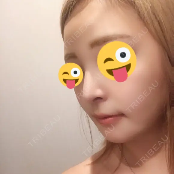 骨切り（あご） / 骨削り（エラ） / 骨削り（頬） / 脂肪吸引（顔） / ヒアルロン酸溶解 View美容整形外科 DAY 41 メイン用