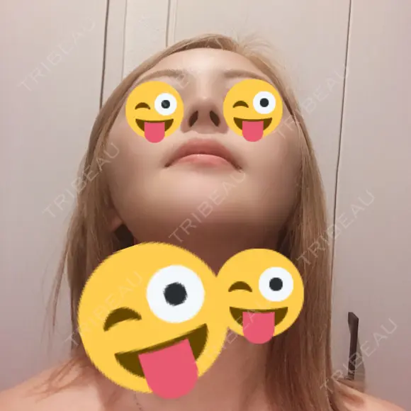 骨切り（あご） / 骨削り（エラ） / 骨削り（頬） / 脂肪吸引（顔） / ヒアルロン酸溶解 View美容整形外科 DAY 41 メイン用