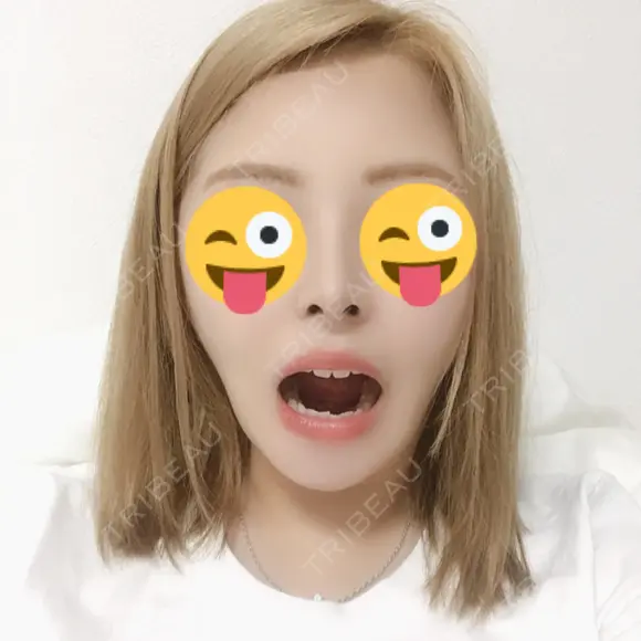 骨切り（あご） / 骨削り（エラ） / 骨削り（頬） / 脂肪吸引（顔） / ヒアルロン酸溶解 View美容整形外科 DAY 41 メイン用