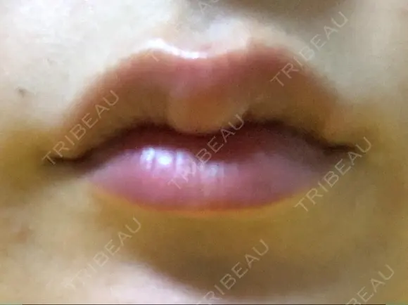 ヒアルロン酸注入（唇） / ボトックス（口角） id美容クリニック 銀座院 DAY 0 メイン用