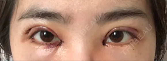 二重切開 / 目頭切開 / 眼瞼下垂（切開） / 目尻切開 ジュエリー美容外科 DAY 1 メイン用