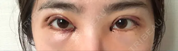 二重切開 / 目頭切開 / 眼瞼下垂（切開） / 目尻切開 ジュエリー美容外科 DAY 2 メイン用