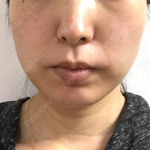 脂肪溶解注射（顔） ビクアスクリニック AFTER メイン用