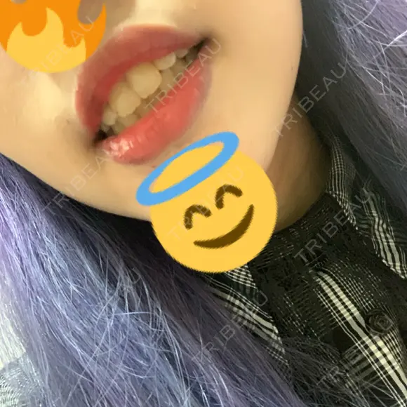 口唇縮小術 / PRP皮膚再生療法 品川スキンクリニック福岡院 DAY 8 メイン用