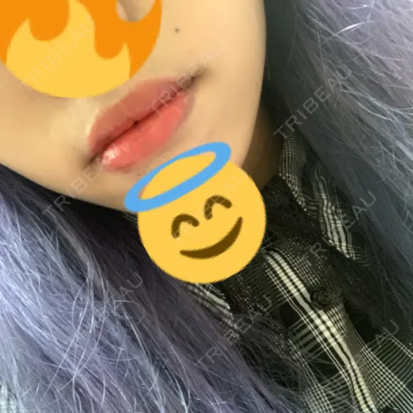 口唇縮小術 / PRP皮膚再生療法 品川スキンクリニック福岡院 DAY 8 メイン用