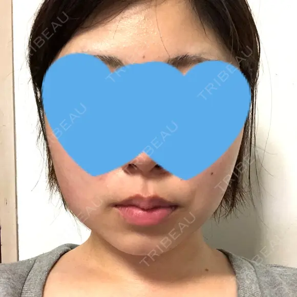 脂肪吸引（顔） GRACIA clinic 【グラシアクリニック】 AFTER メイン用