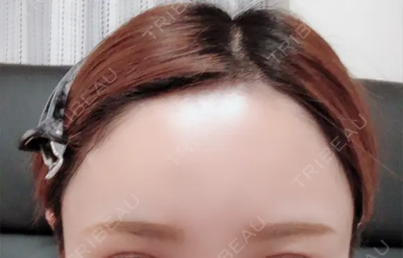 脂肪注入（肌） / 再生医療 / PRP皮膚再生療法 iSTAR美容外科・皮膚科 DAY 63 メイン用