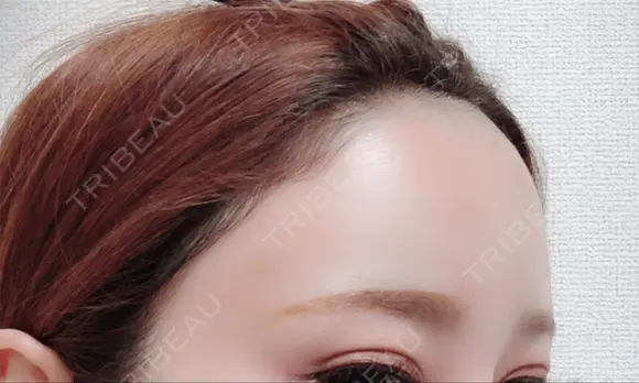 脂肪注入（肌） / 再生医療 / PRP皮膚再生療法 iSTAR美容外科・皮膚科 DAY 65 メイン用