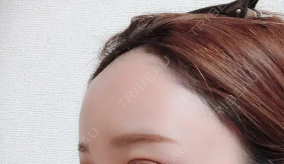 脂肪注入（肌） / 再生医療 / PRP皮膚再生療法 iSTAR美容外科・皮膚科 DAY 65 メイン用