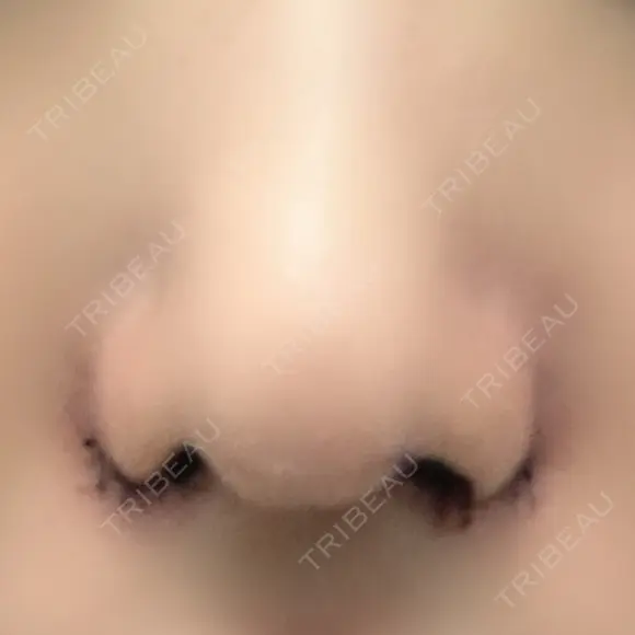 小鼻縮小（切開） キップン整形外科 DAY 2 メイン用