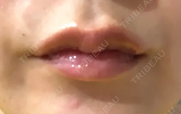 ヒアルロン酸注入（唇） / ボトックス（口角） id美容クリニック 銀座院 AFTER メイン用