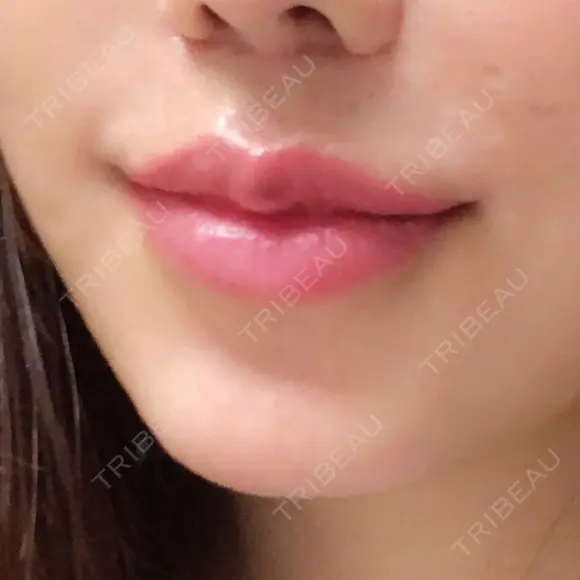 人中短縮 / 口唇縮小術 / 口角挙上 HB整形外科 AFTER メイン用