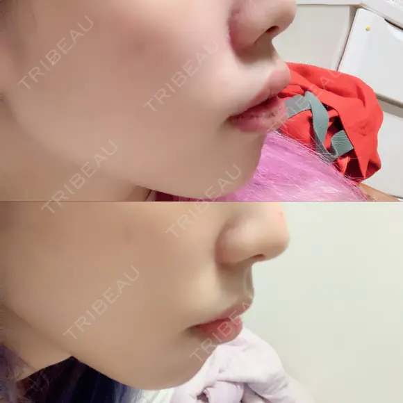 口唇縮小術 / PRP皮膚再生療法 品川スキンクリニック福岡院 AFTER メイン用