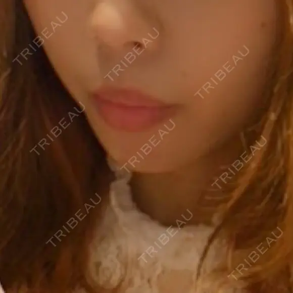 口唇縮小術 / PRP皮膚再生療法 品川スキンクリニック福岡院 DAY 9 メイン用