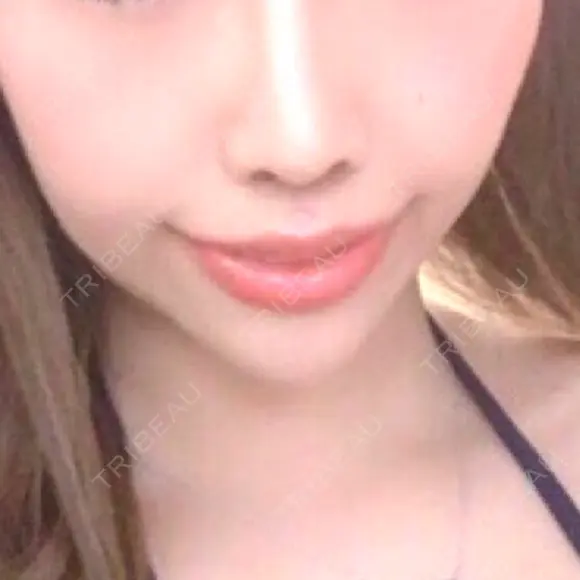 人中短縮 / 口角挙上 清潭女神美容外科 DAY 22 メイン用