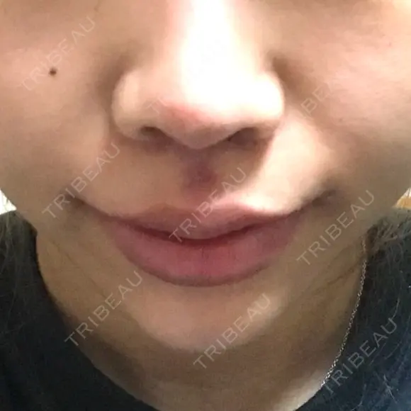 人中短縮 / 口角挙上 清潭女神美容外科 DAY 22 メイン用