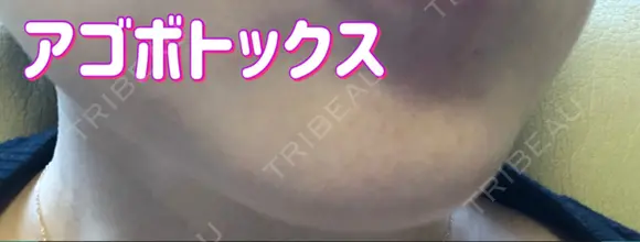 ボトックス（あご） / その他（目元） 金沢美容外科クリニック AFTER メイン用