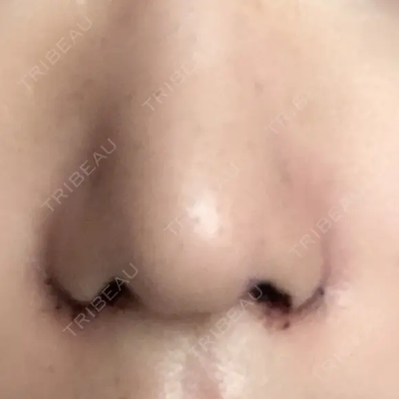 小鼻縮小（切開） キップン整形外科 DAY 3 メイン用