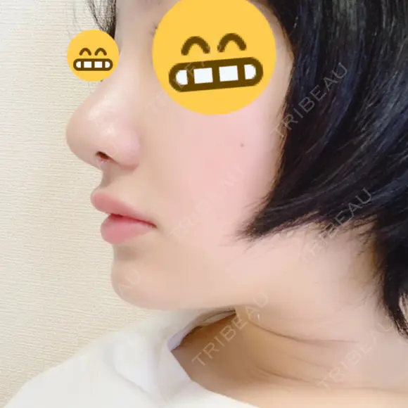 小鼻縮小（切開） / 軟骨移植 / 斜鼻修正 キップン整形外科 DAY 9 メイン用