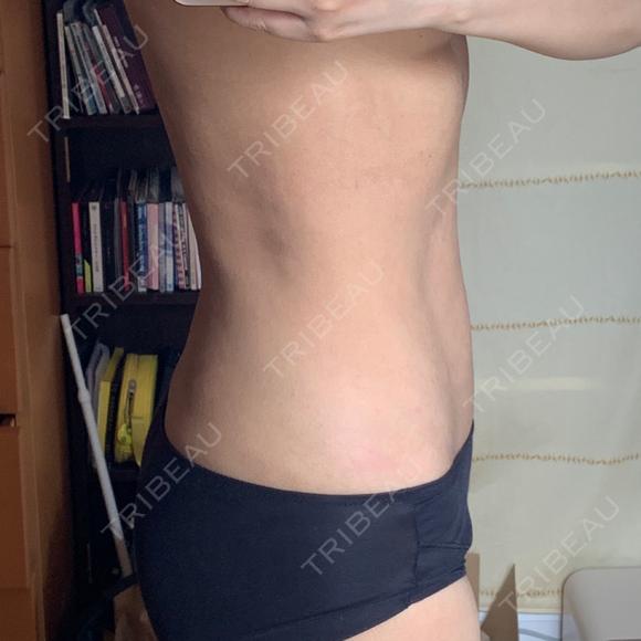 脂肪吸引（お腹） 聖心美容クリニック 札幌院 DAY 240 メイン用